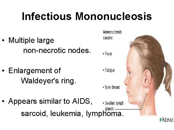 Infectious Mononucleosis • Multiple large non-necrotic nodes. • Enlargement of Waldeyer's ring. • Appears