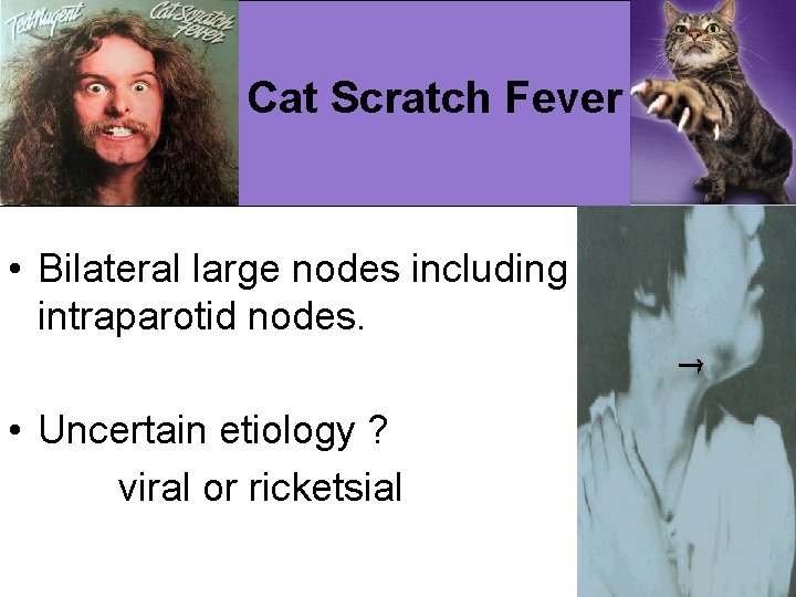 Cat Scratch Fever • Bilateral large nodes including intraparotid nodes. • Uncertain etiology ?
