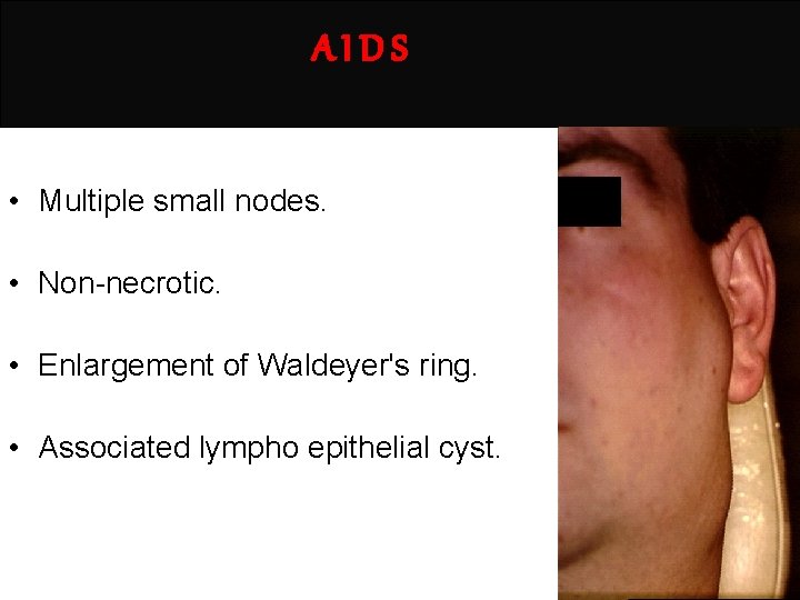 AIDS • Multiple small nodes. • Non-necrotic. • Enlargement of Waldeyer's ring. • Associated