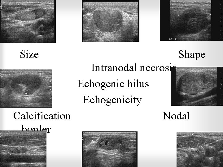 Size Shape Intranodal necrosis Echogenic hilus Echogenicity Calcification Nodal border 