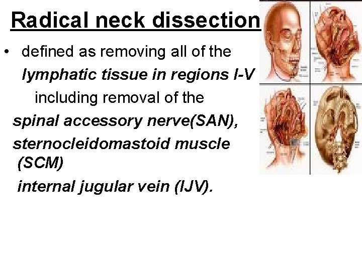 Radical neck dissection • defined as removing all of the lymphatic tissue in regions