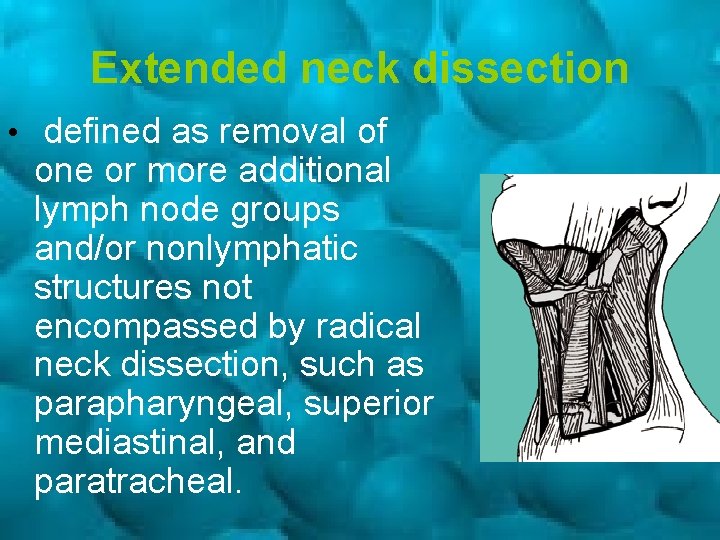 Extended neck dissection • defined as removal of one or more additional lymph node