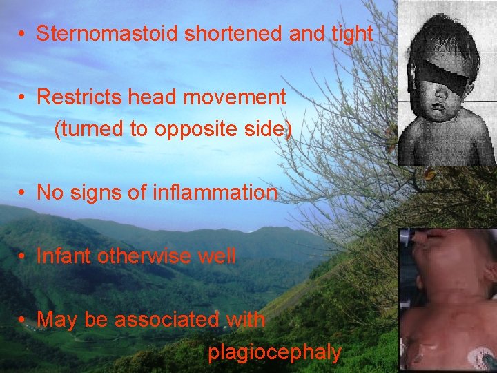  • Sternomastoid shortened and tight • Restricts head movement (turned to opposite side)