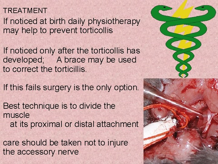 TREATMENT If noticed at birth daily physiotherapy may help to prevent torticollis If noticed