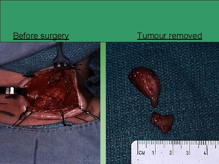Before surgery Tumour removed 