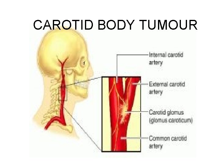 CAROTID BODY TUMOUR 