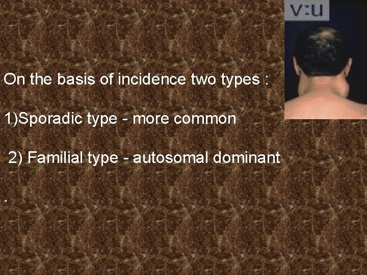 On the basis of incidence two types : 1)Sporadic type - more common 2)