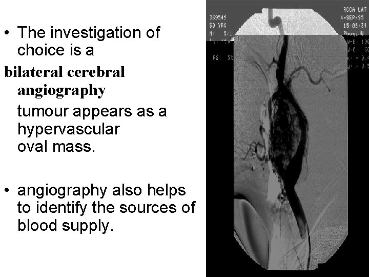  • The investigation of choice is a bilateral cerebral angiography tumour appears as