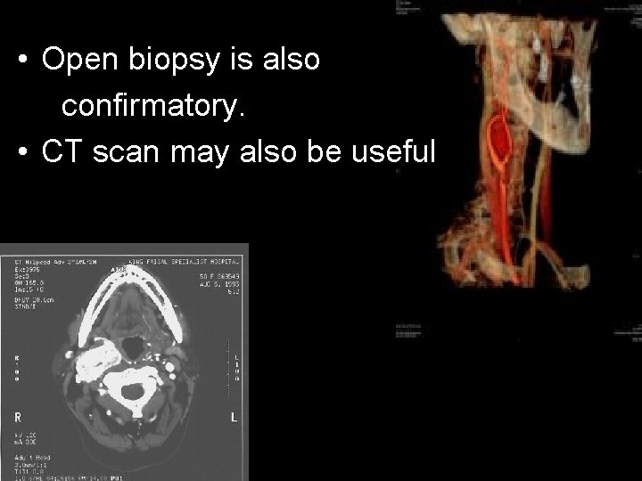  • Open biopsy is also confirmatory. • CT scan may also be useful