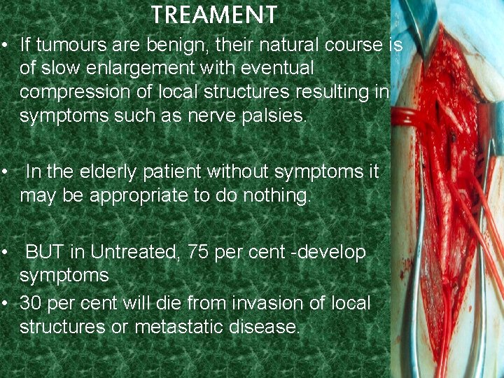 TREAMENT • If tumours are benign, their natural course is of slow enlargement with