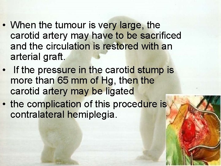  • When the tumour is very large, the carotid artery may have to