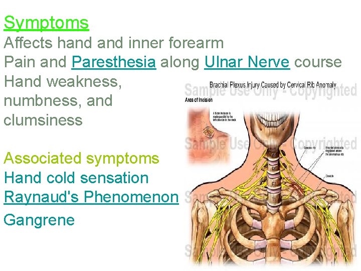 Symptoms Affects hand inner forearm Pain and Paresthesia along Ulnar Nerve course Hand weakness,