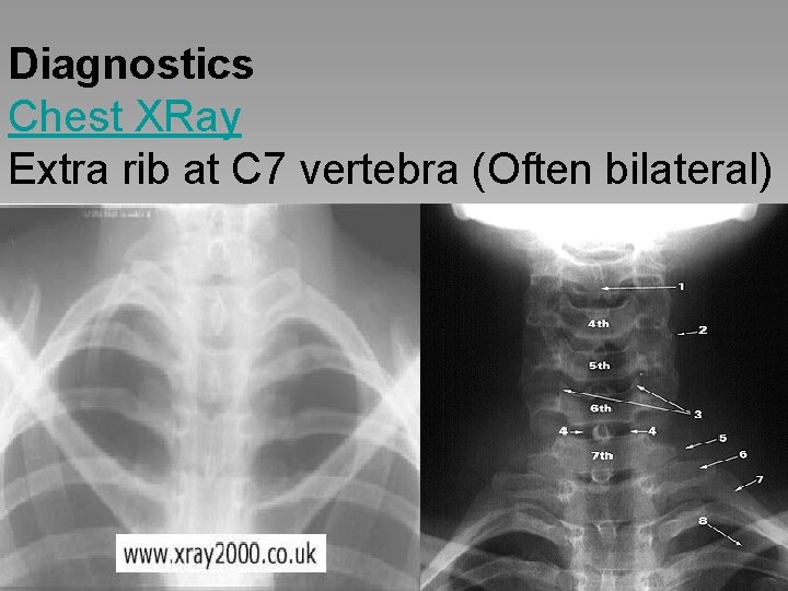 Diagnostics Chest XRay Extra rib at C 7 vertebra (Often bilateral) 