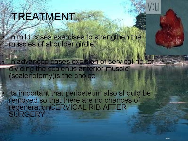 TREATMENT • In mild cases exercises to strengthen the muscles of shoulder girdle. •