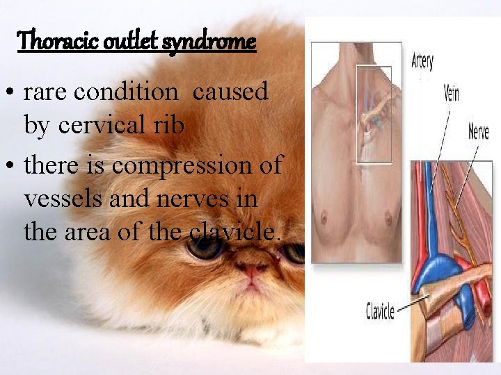 Thoracic outlet syndrome • rare condition caused by cervical rib • there is compression