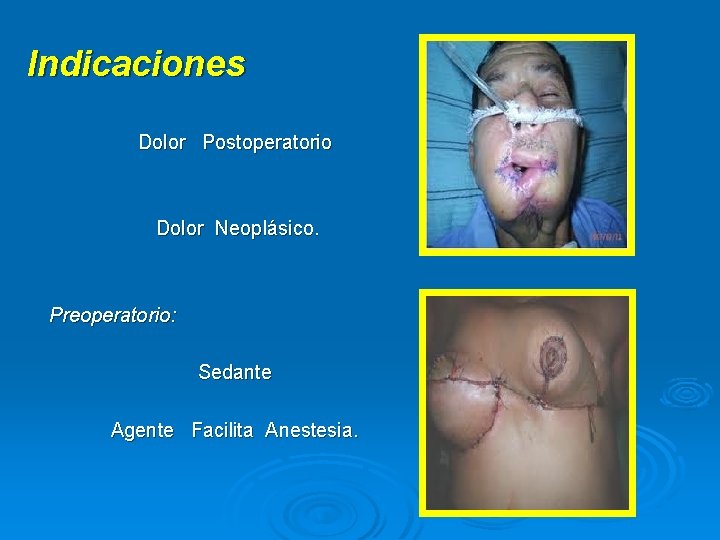 Indicaciones Dolor Postoperatorio Dolor Neoplásico. Preoperatorio: Sedante Agente Facilita Anestesia. 