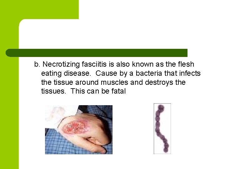 b. Necrotizing fasciitis is also known as the flesh eating disease. Cause by a