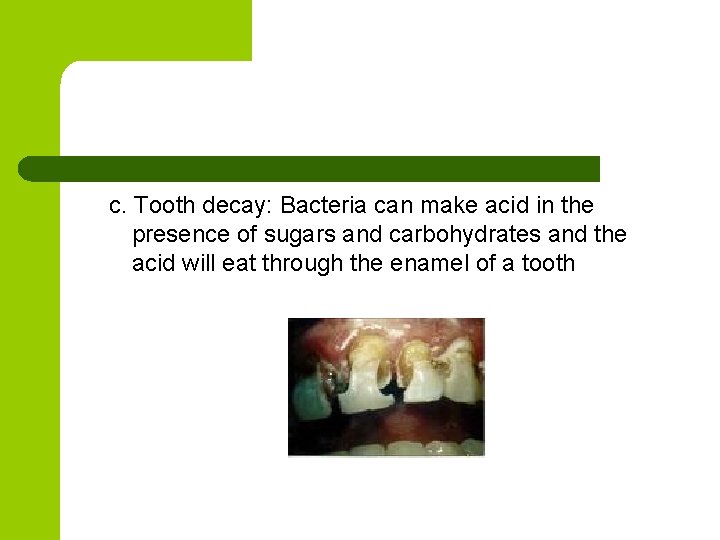 c. Tooth decay: Bacteria can make acid in the presence of sugars and carbohydrates