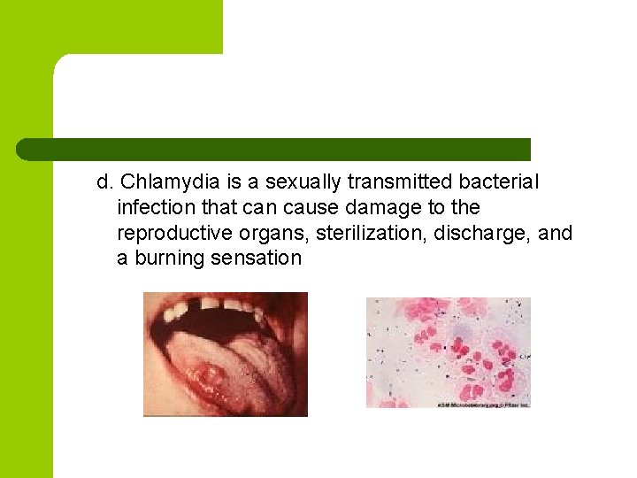 d. Chlamydia is a sexually transmitted bacterial infection that can cause damage to the