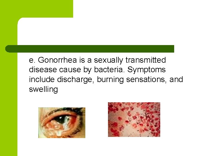 e. Gonorrhea is a sexually transmitted disease cause by bacteria. Symptoms include discharge, burning