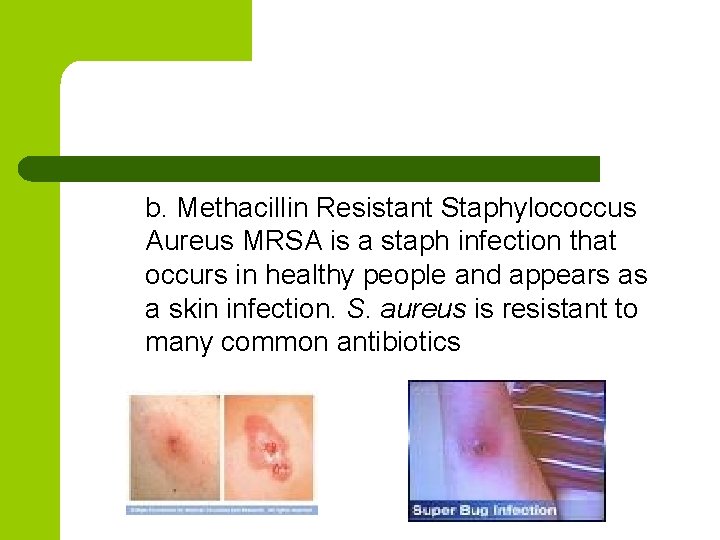 b. Methacillin Resistant Staphylococcus Aureus MRSA is a staph infection that occurs in healthy