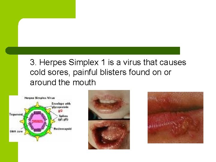 3. Herpes Simplex 1 is a virus that causes cold sores, painful blisters found