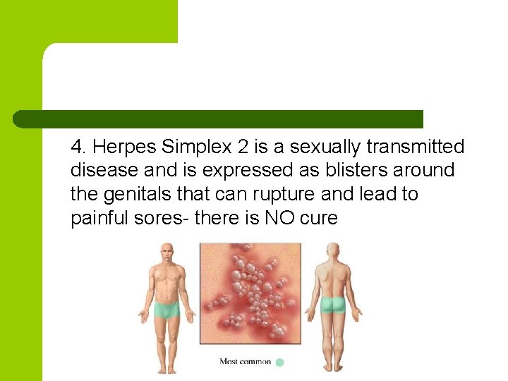 4. Herpes Simplex 2 is a sexually transmitted disease and is expressed as blisters