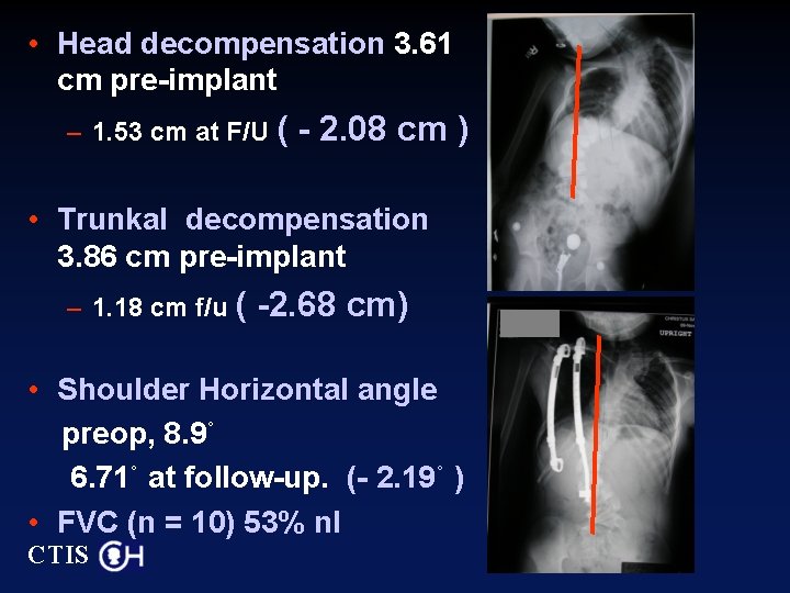  • Head decompensation 3. 61 cm pre-implant – 1. 53 cm at F/U