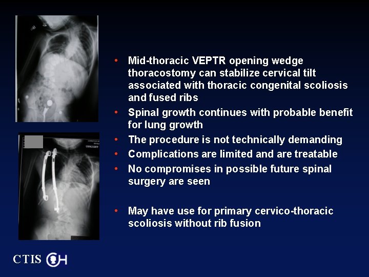  • Mid-thoracic VEPTR opening wedge thoracostomy can stabilize cervical tilt associated with thoracic