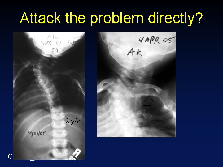 Attack the problem directly? 2 y/o CTIS 
