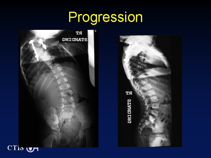 Progression CTIS 