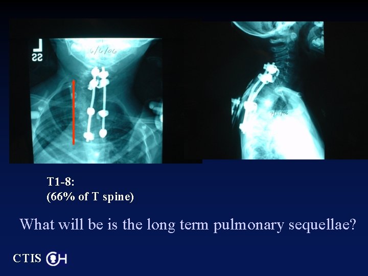 T 1 -8: (66% of T spine) What will be is the long term