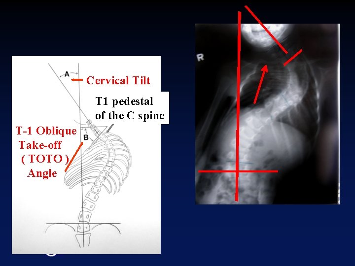 Cervical Tilt T 1 pedestal of the C spine T-1 Oblique Take-off ( TOTO