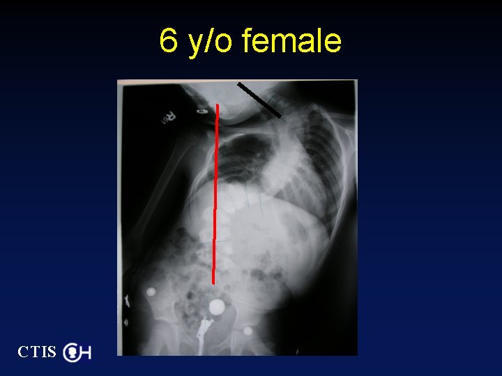 6 y/o female CTIS 