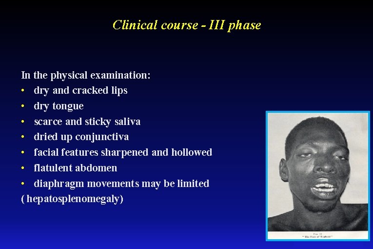 Clinical course - III phase In the physical examination: • dry and cracked lips