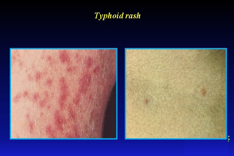 Typhoid rash 