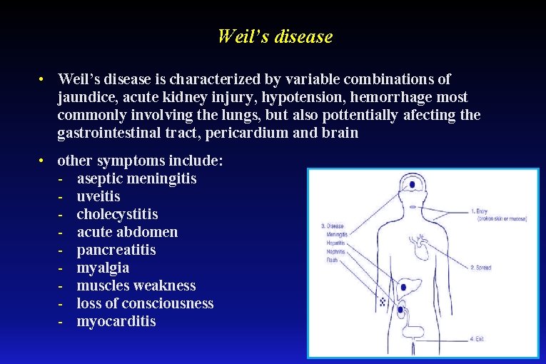 Weil’s disease • Weil’s disease is characterized by variable combinations of jaundice, acute kidney