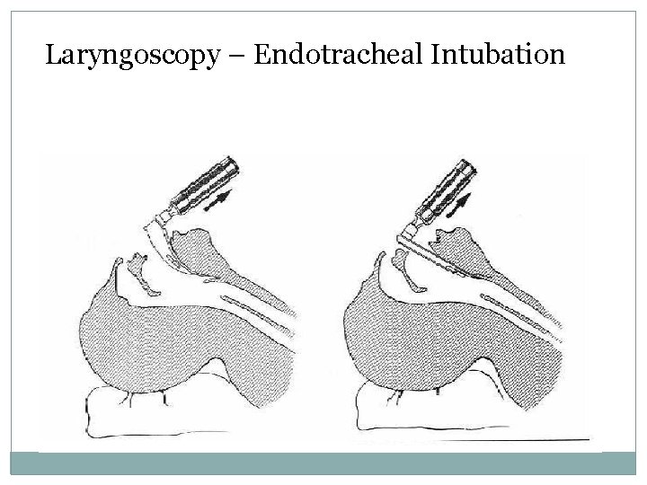 Laryngoscopy – Endotracheal Intubation 