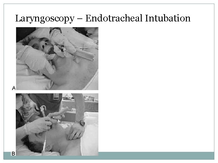 Laryngoscopy – Endotracheal Intubation 