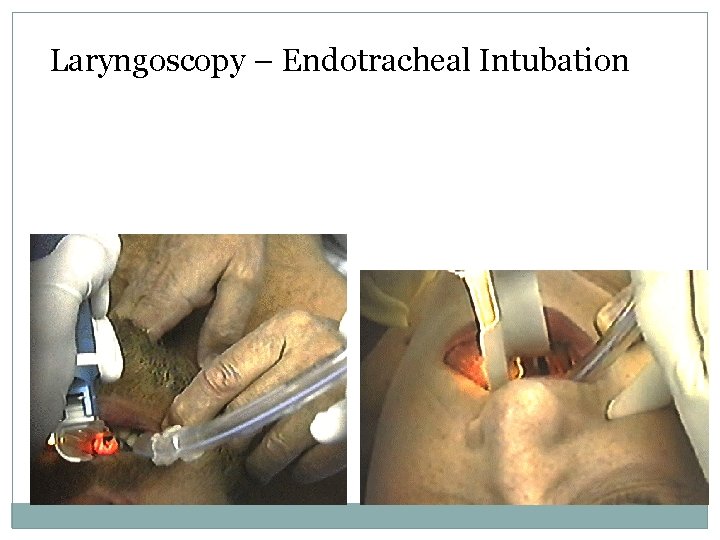 Laryngoscopy – Endotracheal Intubation 