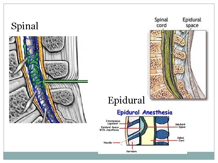 Spinal Epidural 