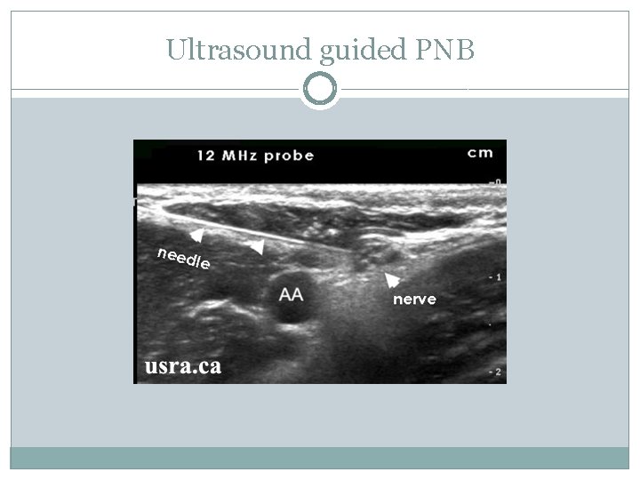 Ultrasound guided PNB 