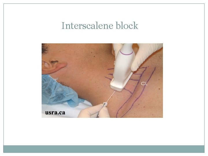 Interscalene block 