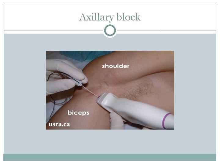 Axillary block 