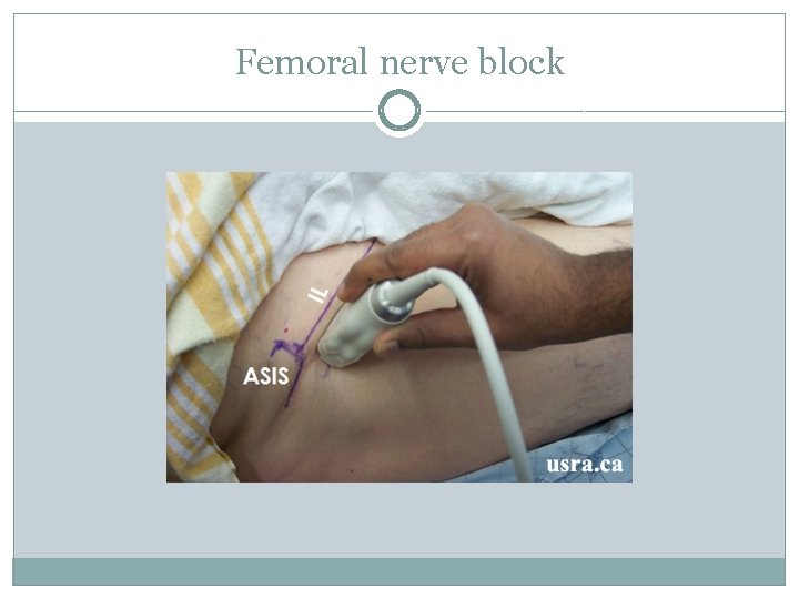 Femoral nerve block 