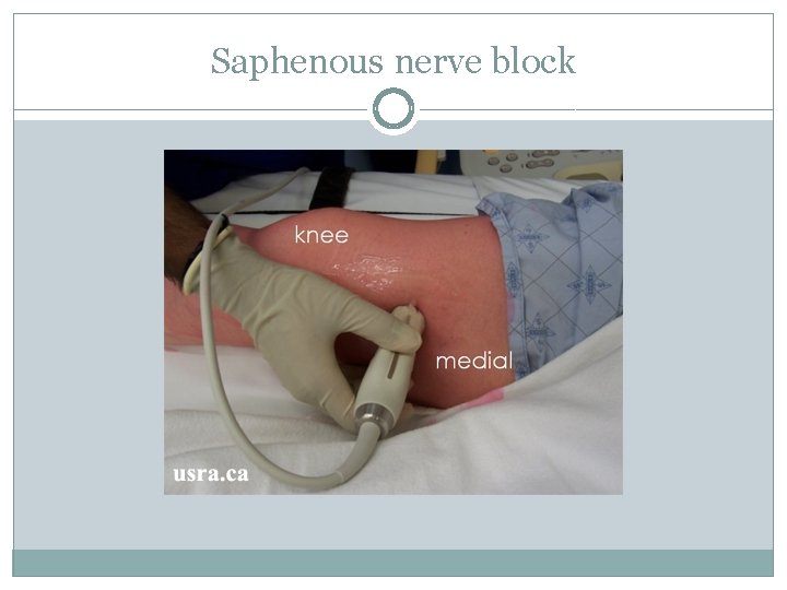 Saphenous nerve block 