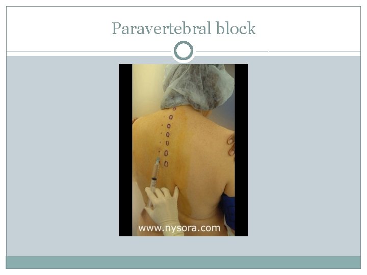 Paravertebral block 