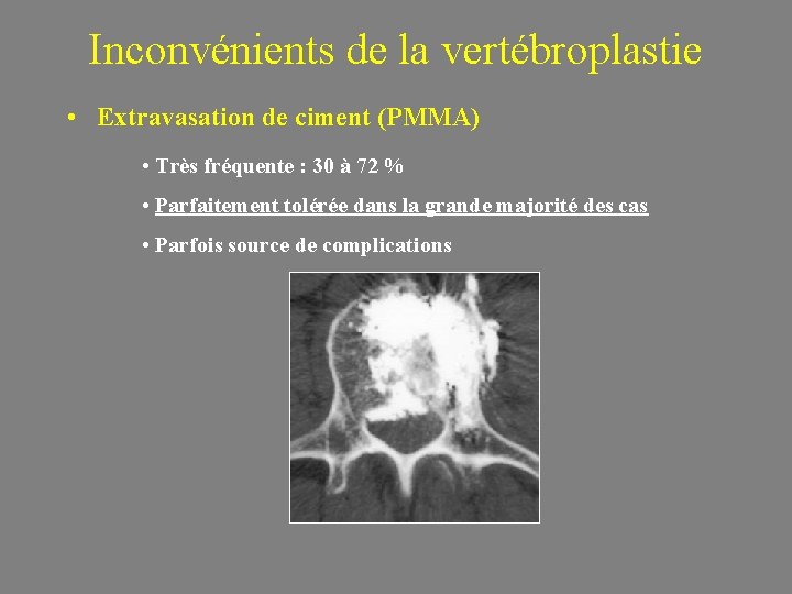 Inconvénients de la vertébroplastie • Extravasation de ciment (PMMA) • Très fréquente : 30