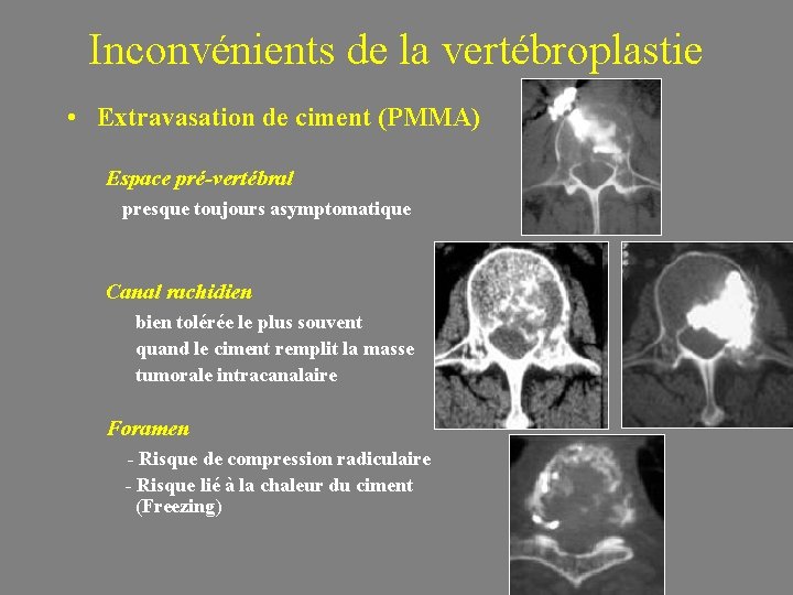 Inconvénients de la vertébroplastie • Extravasation de ciment (PMMA) Espace pré-vertébral presque toujours asymptomatique