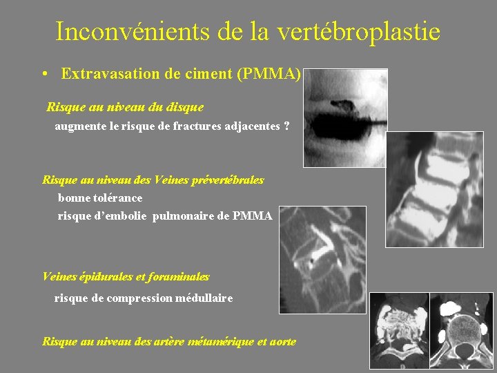 Inconvénients de la vertébroplastie • Extravasation de ciment (PMMA) Risque au niveau du disque